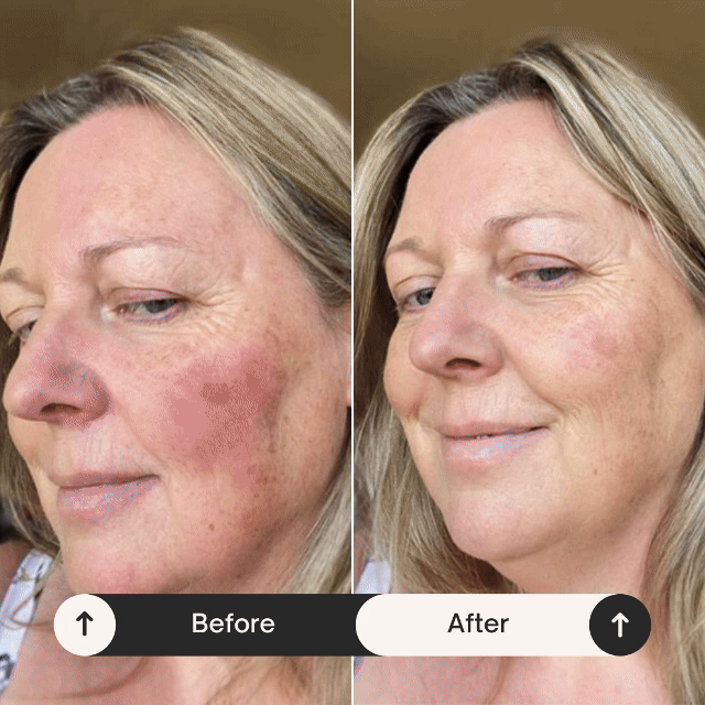 MEDIGLOW™ High Frequency Wand